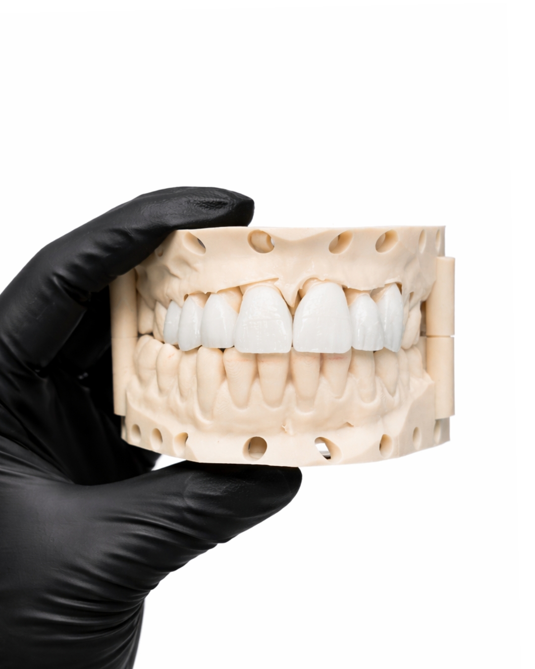 E.max Veneer  -  materials
